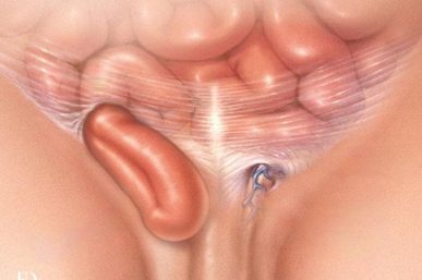 4 Hernia